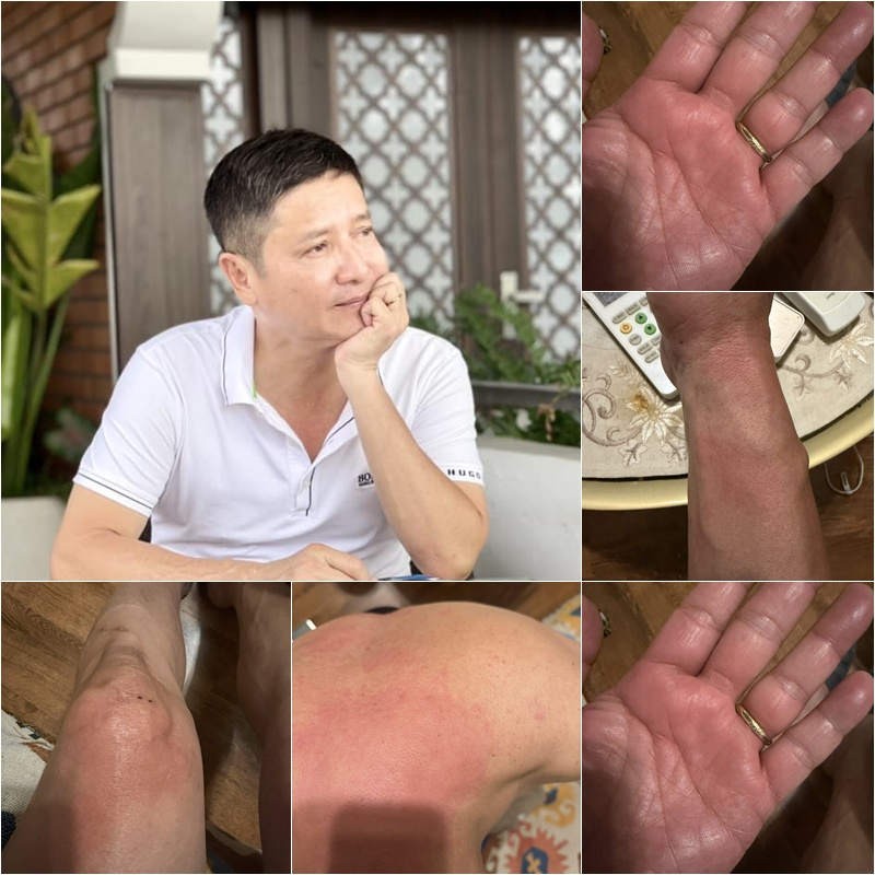 NSƯT Chí Trung mắc bệnh lạ